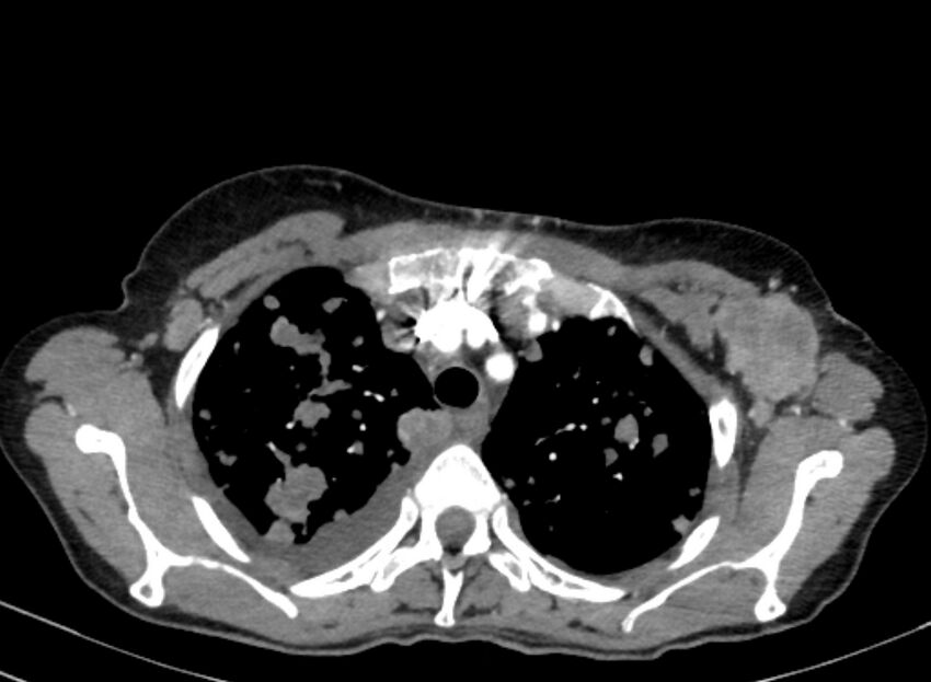 Cannonball metastases from breast cancer (Radiopaedia 91024-108569 A 31).jpg