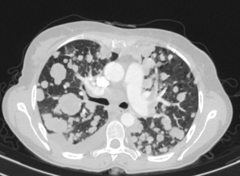File:Cannonball metastases from breast cancer (Radiopaedia 91024-108569 Axial lung window 37).jpg