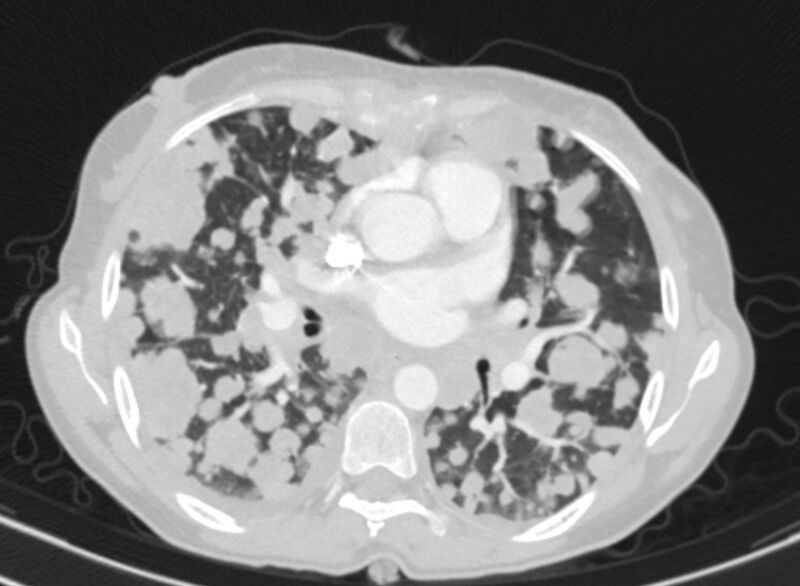 File:Cannonball metastases from breast cancer (Radiopaedia 91024-108569 Axial lung window 49).jpg