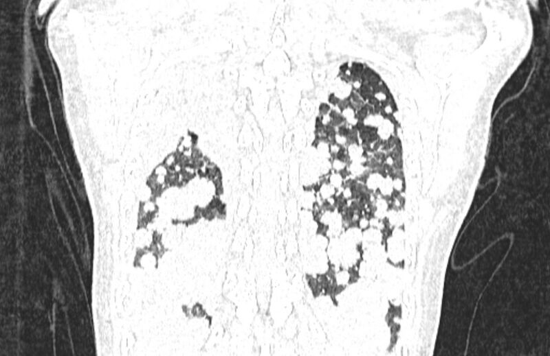 File:Cannonball metastases from breast cancer (Radiopaedia 91024-108569 Coronal lung window 125).jpg