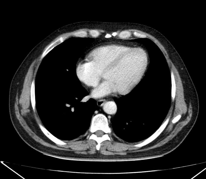 File:Carcinoid tumor with hepatic metastases (Radiopaedia 22651-22670 C 24).jpg