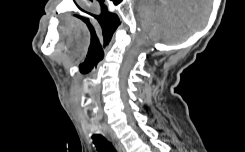 Carotid artery pseudoaneurysm (Radiopaedia 84030-99259 E 7).jpg