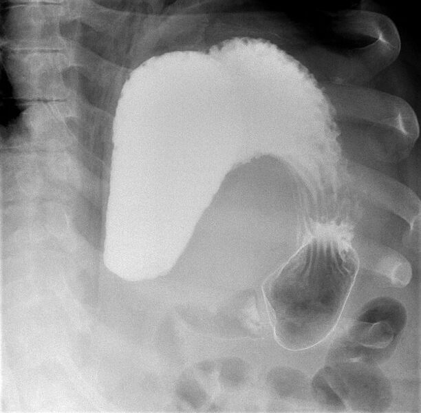 File:Cascade stomach (Radiopaedia 89762-106852 Supine frontal 1).JPG