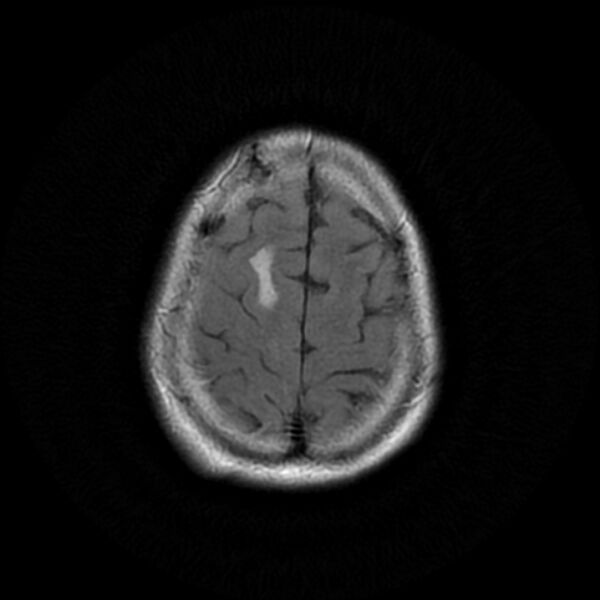 File:Central neurocytoma (Radiopaedia 67618-77021 Axial FLAIR 22).jpg