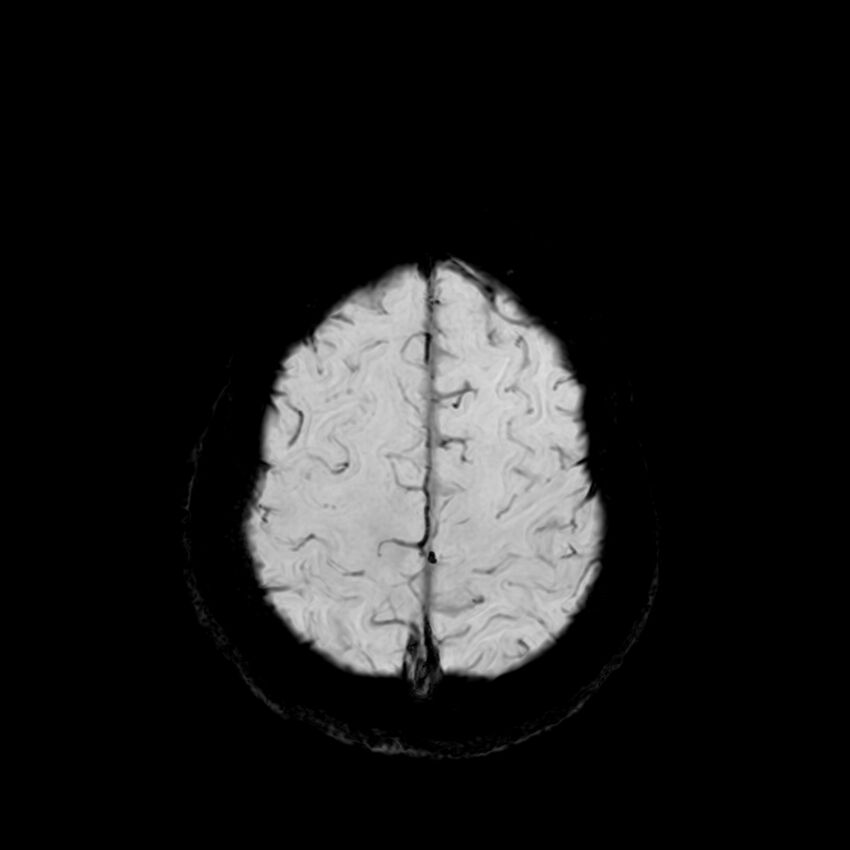 Central neurocytoma (Radiopaedia 79320-92380 Axial SWI 119).jpg
