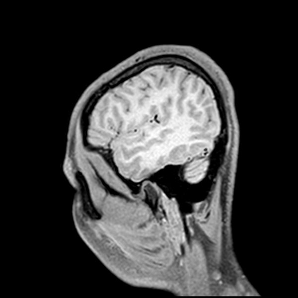 File:Central neurocytoma (Radiopaedia 79320-92380 Sagittal T1 215).jpg