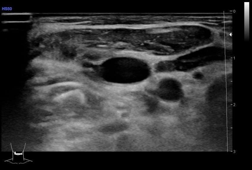 Central venous catheter-related thrombosis (Radiopaedia 61135-69025 Transverse 86).jpg
