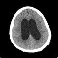 Cerebellar abscess secondary to mastoiditis (Radiopaedia 26284-26412 Axial non-contrast 108).jpg