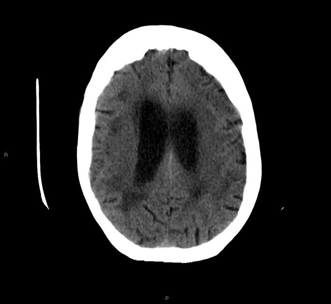 File:Cerebellar hemorrhage (Radiopaedia 58792-66026 Axial non-contrast 18).jpg