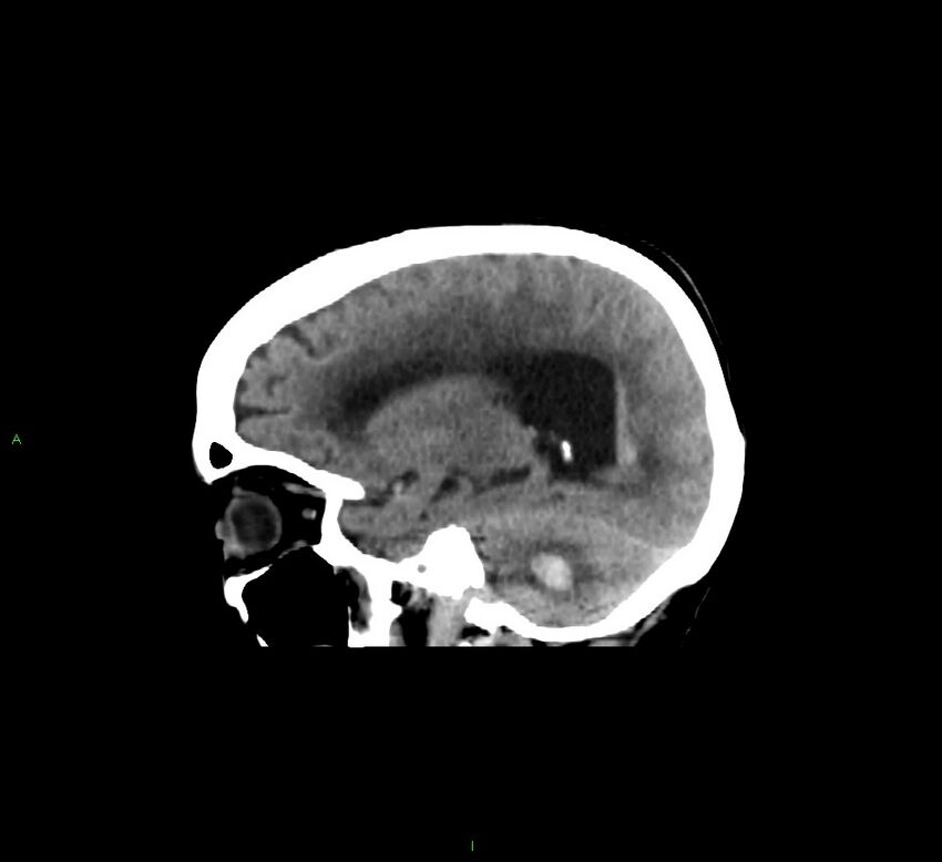 Cerebellar hemorrhage (Radiopaedia 58793-66027 C 19).jpg