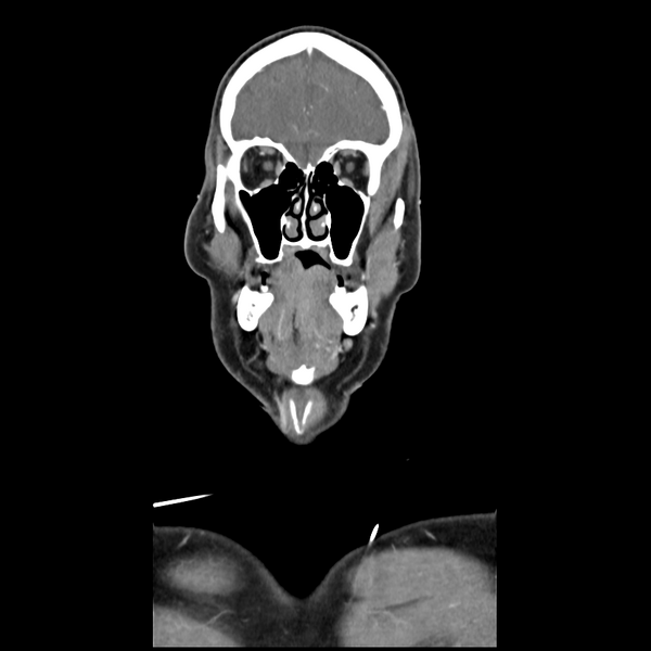 File:Cerebellar infarct due to vertebral artery dissection with posterior fossa decompression (Radiopaedia 82779-97029 D 14).png