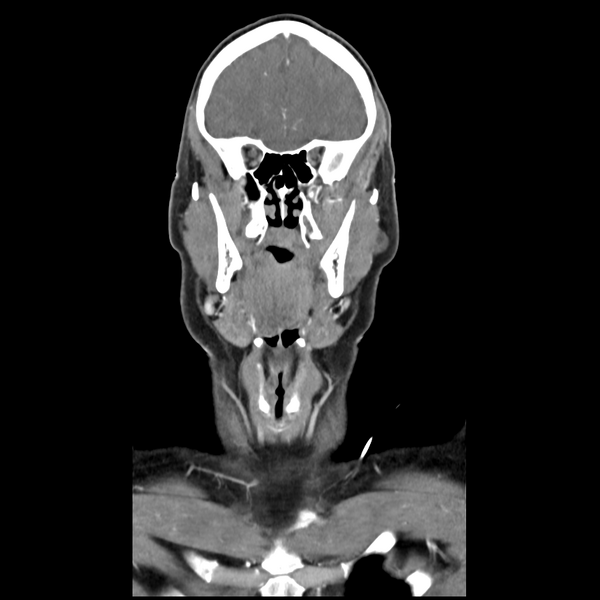 File:Cerebellar infarct due to vertebral artery dissection with posterior fossa decompression (Radiopaedia 82779-97029 D 18).png