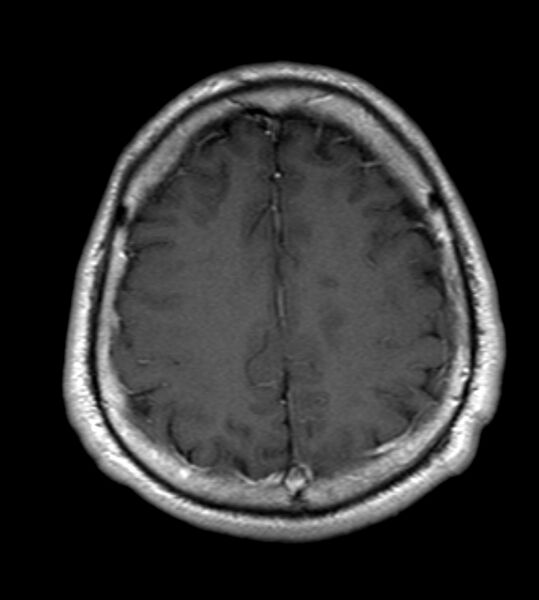 File:Cerebellopontine angle meningioma (Radiopaedia 24459-24764 Axial T1 C+ 19).jpg