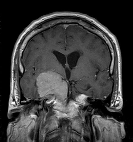 File:Cerebellopontine angle meningioma (Radiopaedia 24459-24764 Coronal T1 C+ 10).jpg