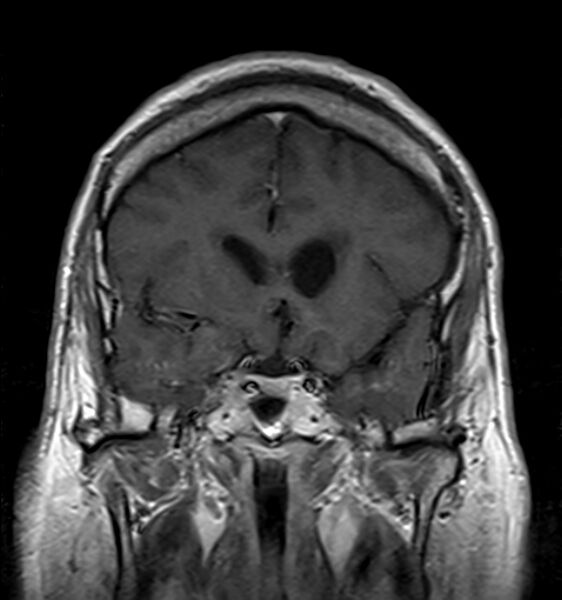 File:Cerebellopontine angle meningioma (Radiopaedia 24459-24764 Coronal T1 C+ 7).jpg