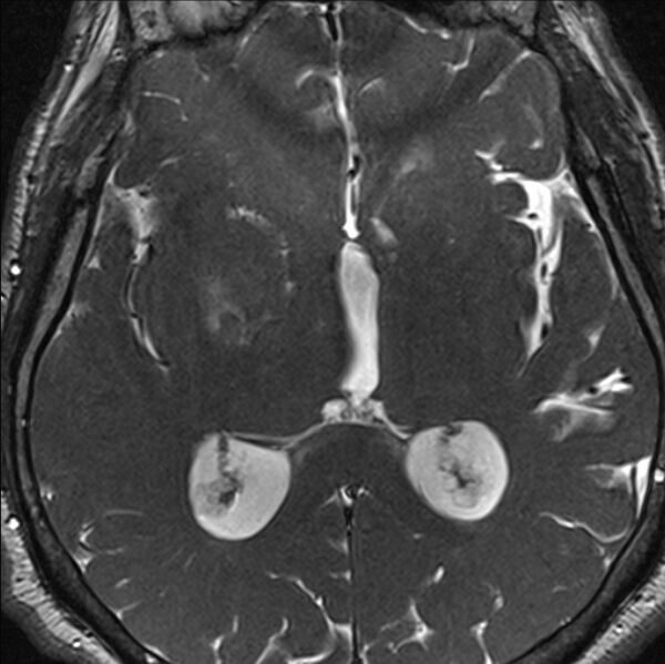 File:Cerebellopontine angle meningioma (Radiopaedia 24459-24764 I 54).jpg