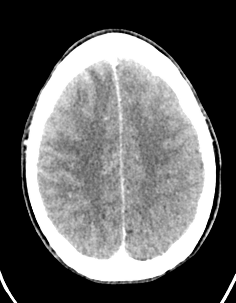 File:Cerebral abscess (Radiopaedia 60342-68008 Axial C+ delayed 38).png