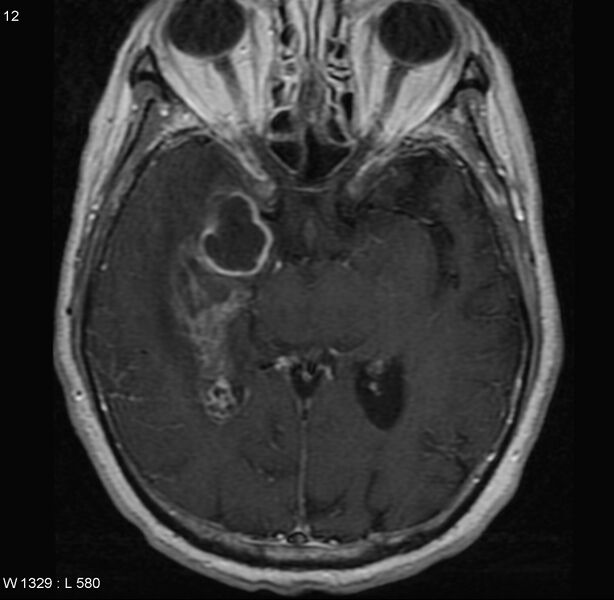 File:Cerebral abscess and ventriculitis (Radiopaedia 5024-6885 Axial T1 C+ 3).jpg