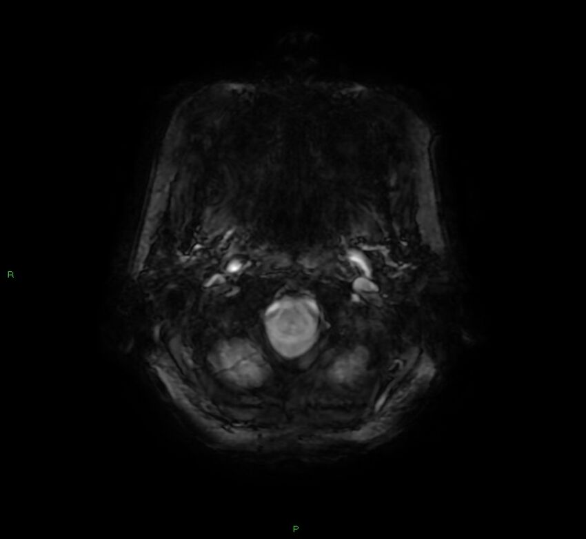 Cerebral amyloid angiopathy-associated lobar intracerebral hemorrhage (Radiopaedia 58378-65517 Axial SWI 5).jpg