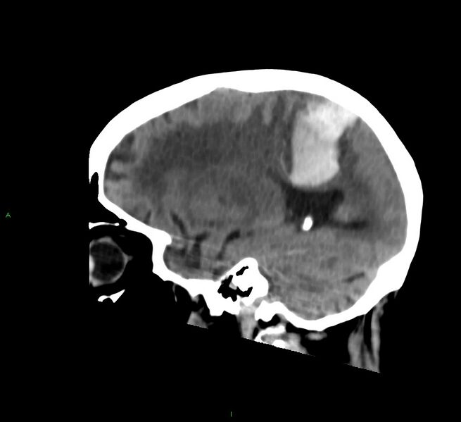 File:Cerebral amyloid angiopathy-associated lobar intracerebral hemorrhage (Radiopaedia 58530-65688 C 37).jpg