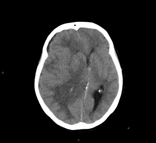 File:Cerebral amyloid angiopathy-associated lobar intracerebral hemorrhage (Radiopaedia 58751-65972 Axial non-contrast 27).jpg