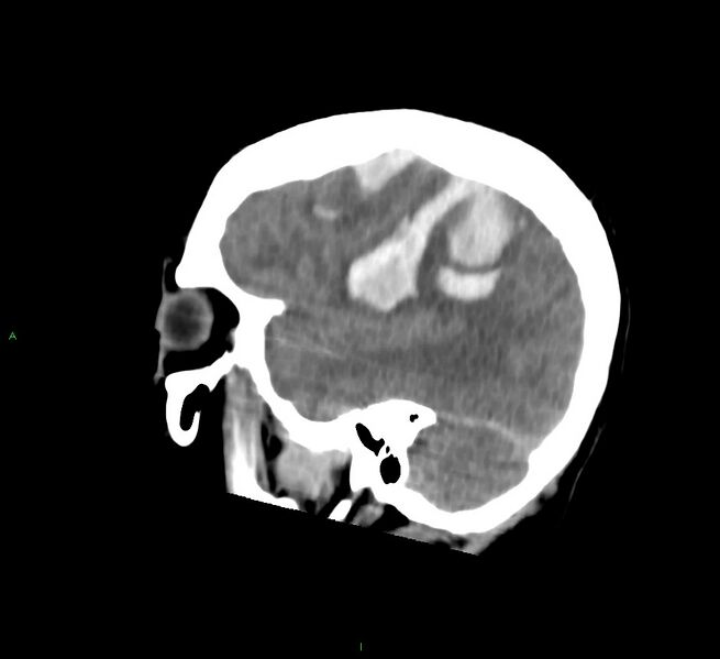 File:Cerebral amyloid angiopathy-associated lobar intracerebral hemorrhage (Radiopaedia 58756-65977 C 16).jpg