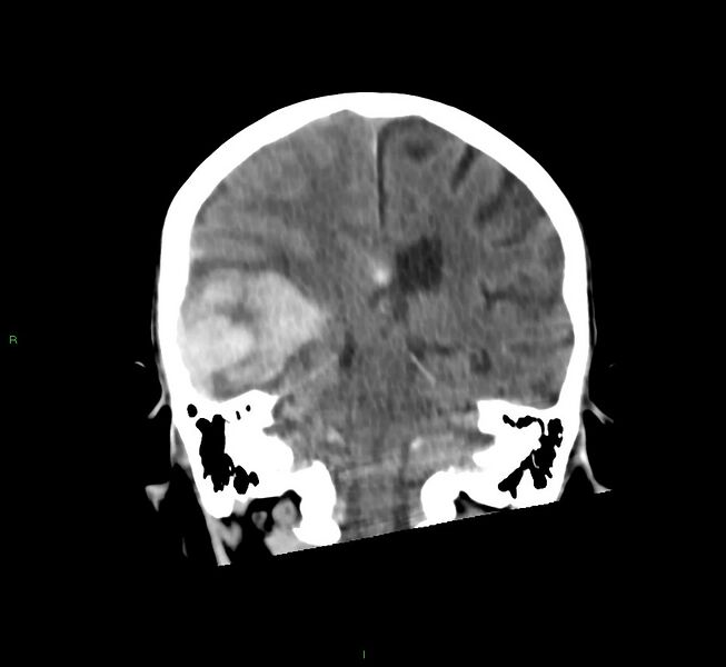 File:Cerebral amyloid angiopathy-associated lobar intracerebral hemorrhage (Radiopaedia 58758-65980 Coronal non-contrast 28).jpg