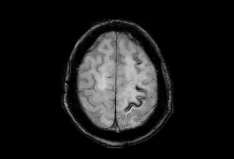 File:Cerebral amyloid angiopathy (Radiopaedia 86671-102792 Axial Gradient Echo 10).jpg