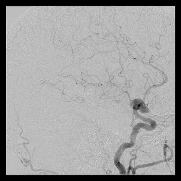 File:Cerebral aneurysm with rupture (Radiopaedia 29933-30458 LT ICA IC 40).jpg
