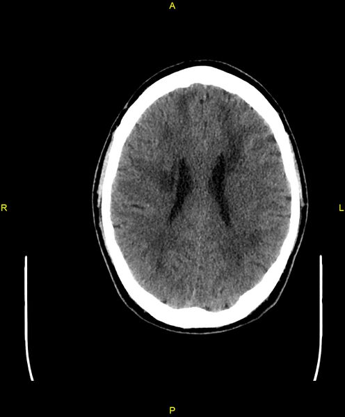 File:Cerebral autosomal dominant arteriopathy with subcortical infarcts and leukoencephalopathy (CADASIL) (Radiopaedia 86108-102051 Axial non-contrast 70).jpg