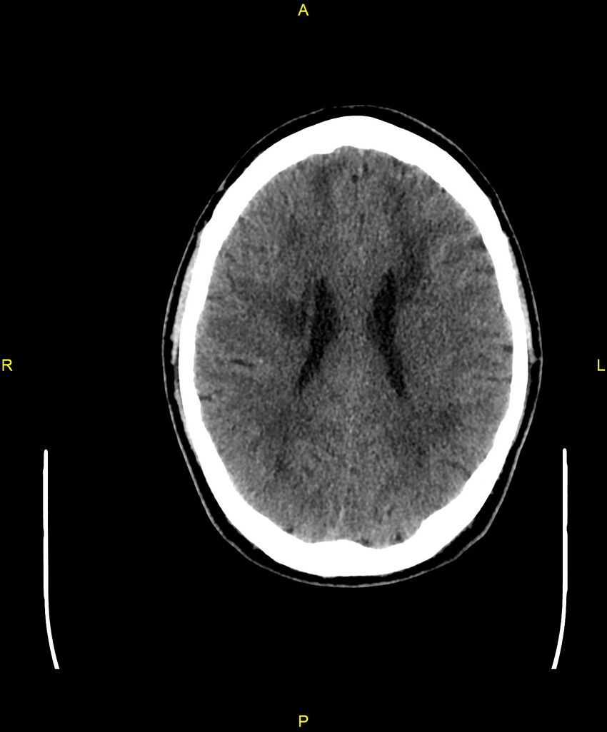 Cerebral autosomal dominant arteriopathy with subcortical infarcts and leukoencephalopathy (CADASIL) (Radiopaedia 86108-102051 Axial non-contrast 70).jpg