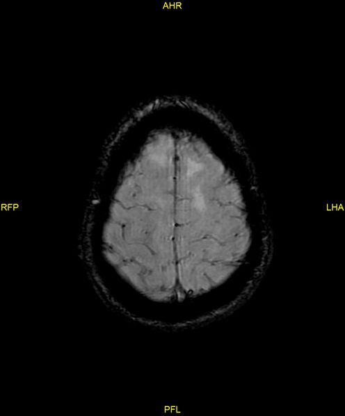 File:Cerebral autosomal dominant arteriopathy with subcortical infarcts and leukoencephalopathy (CADASIL) (Radiopaedia 86108-102054 Axial SWI 92).jpg