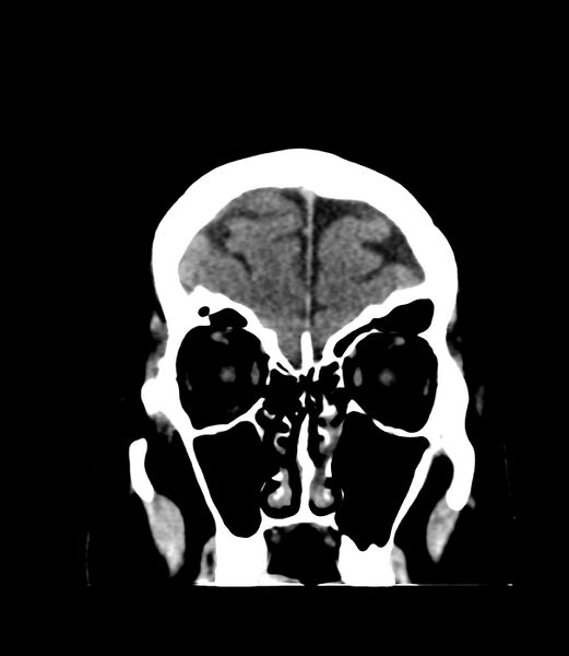 File:Cerebral dural venous sinus thrombosis (Radiopaedia 86514-102575 Coronal non-contrast 4).jpg