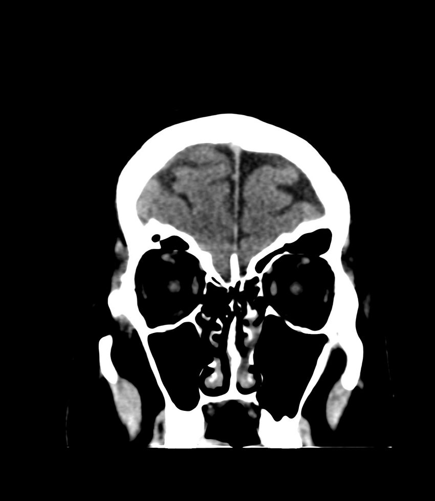 Cerebral dural venous sinus thrombosis (Radiopaedia 86514-102575 Coronal non-contrast 4).jpg
