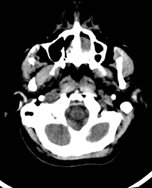 File:Cerebral edema due to severe hyponatremia (Radiopaedia 89826-106938 Axial non-contrast 13).jpg