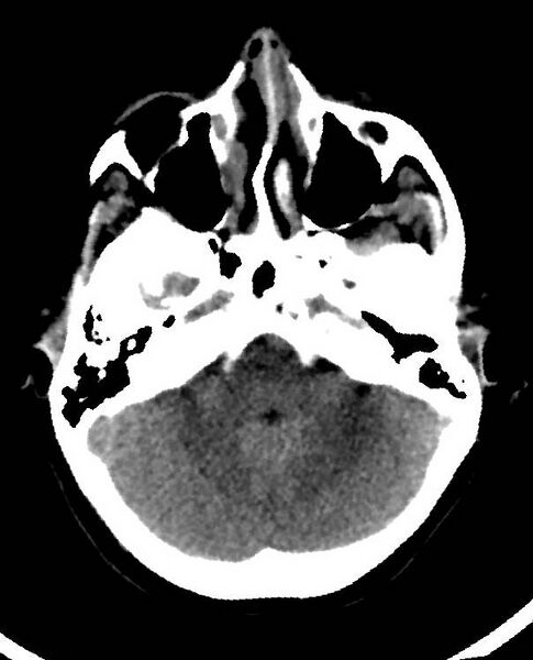 File:Cerebral edema due to severe hyponatremia (Radiopaedia 89826-106938 Axial non-contrast 26).jpg