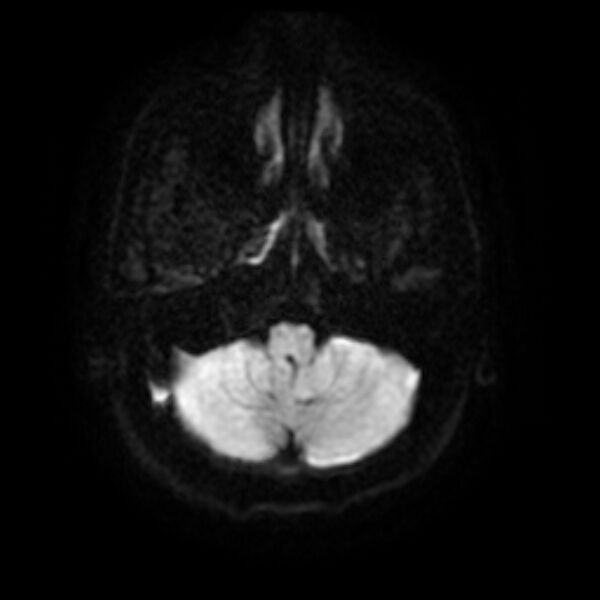 File:Cerebral fat embolism (Radiopaedia 37510-39363 Axial DWI 6).jpg