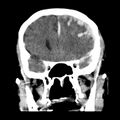 Cerebral hemorrhagic contusions (Radiopaedia 23145-23188 Coronal non-contrast 15).jpg