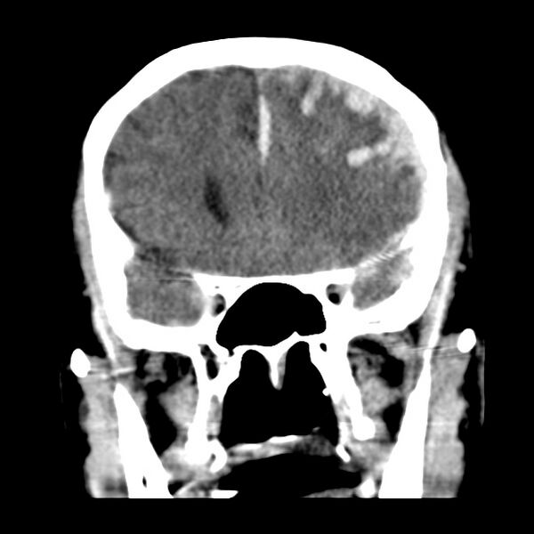 File:Cerebral hemorrhagic contusions (Radiopaedia 23145-23188 Coronal non-contrast 15).jpg