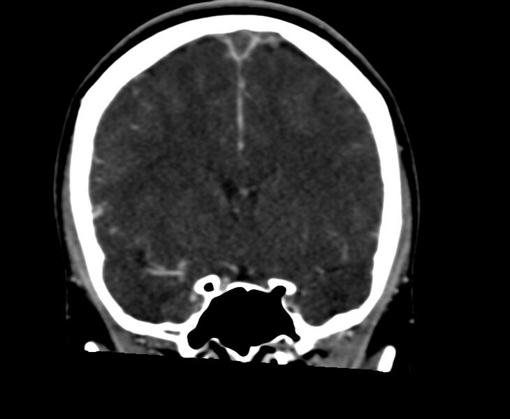 File:Cerebral venous sinus thrombosis (Radiopaedia 59224-66646 Coronal C+ delayed 29).jpg