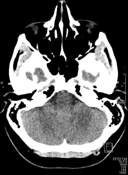 File:Cerebral venous sinus thrombosis (Radiopaedia 91329-108965 Axial non-contrast 11).jpg