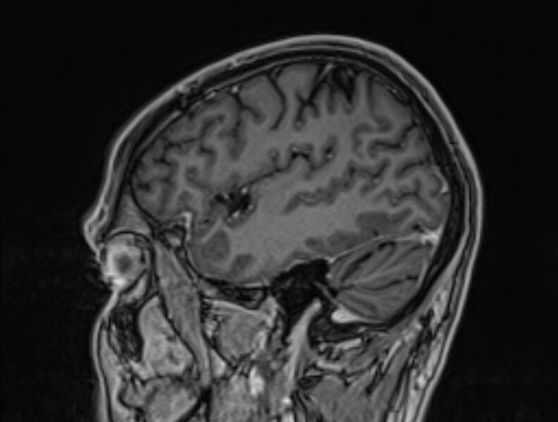 File:Cerebral venous thrombosis (Radiopaedia 71207-81504 Sagittal T1 C+ 11).jpg