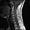 Cervical disc extrusion (Radiopaedia 5216-6982 Sagittal T1 2).jpg