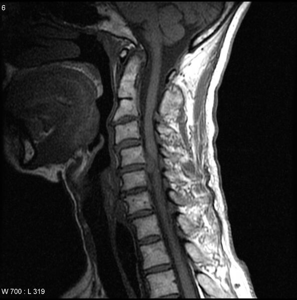 File:Cervical disc extrusion (Radiopaedia 5216-6982 Sagittal T1 2).jpg