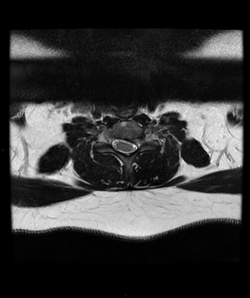 File:Cervical disc prolapse (Radiopaedia 80258-93598 Axial T2 51).jpg