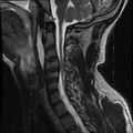 Cervical flexion teardrop fracture with cord hemorrhage (Radiopaedia 32497-33455 Sagittal T2 11).jpg