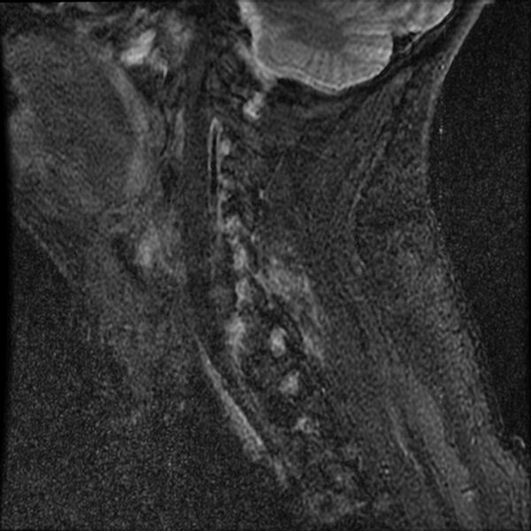 File:Cervical fracture and dislocation with locked facet (Radiopaedia 31837-32781 Sagittal STIR 4).jpg
