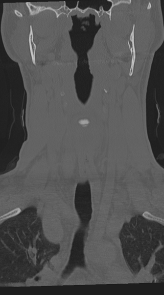File:Cervical intercalary bone (Radiopaedia 35211-36748 Coronal bone window 22).png
