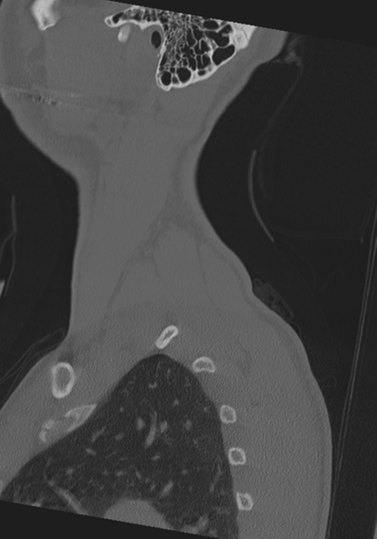 File:Cervical intercalary bone (Radiopaedia 35211-36748 Sagittal bone window 3).png