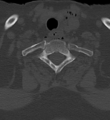 Cervical spine ACDF loosening (Radiopaedia 48998-54070 Axial bone window 50).png